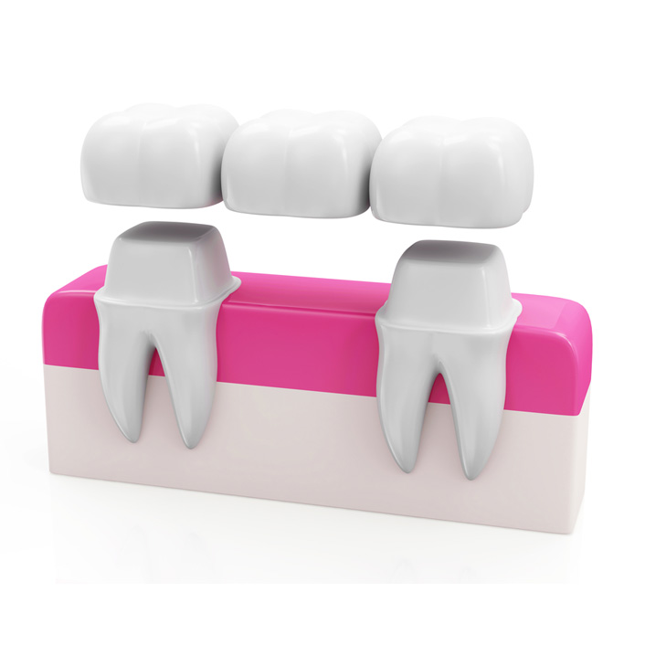 Seymour Dental Crowns